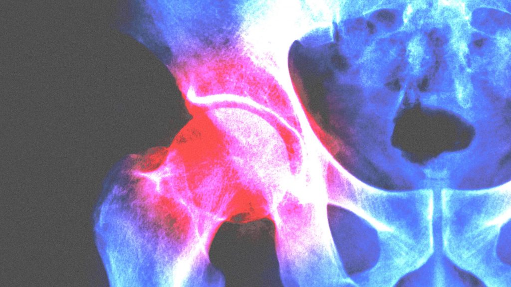 Ayurvedic Medicine For Hip Joint Pain Treatment Options For Hip Pain 2022